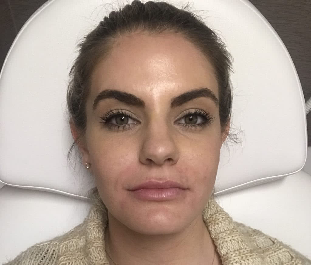 Just after my first time trying Juvederm Vollure lip filler