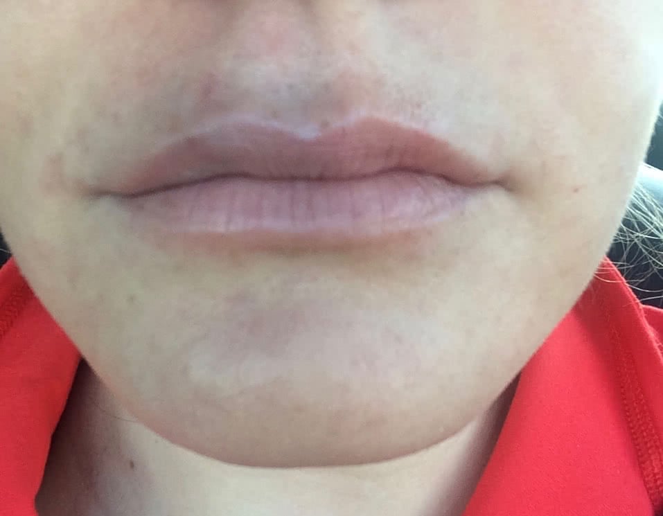 Bruising from my first lip injection treatment