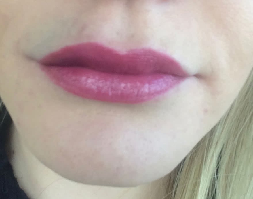 Dark lipstick to help cover up the initial bruising from the Juvederm injection