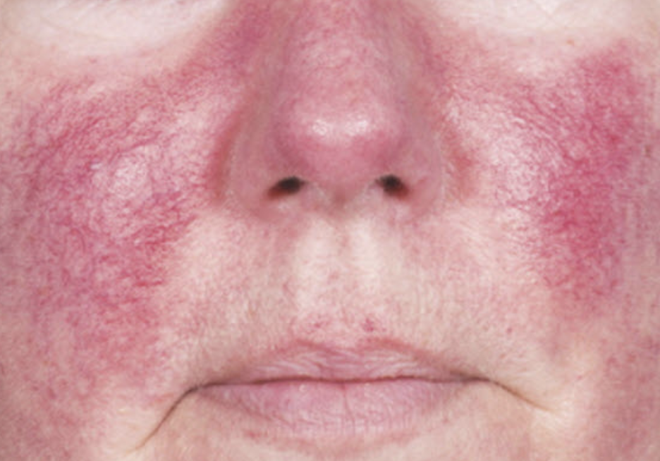 Rosacea Symptoms And Treatment Options Lauren Erro