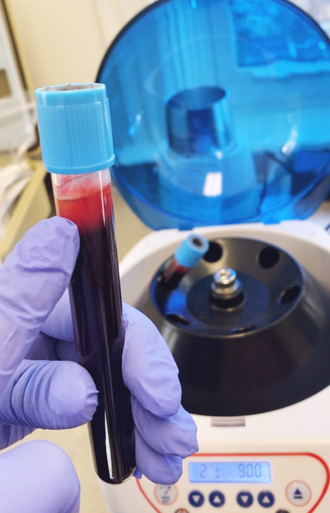 Platelet rich fibrin blood draw