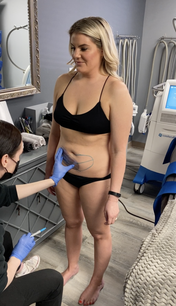 Measuring for coolsculpting