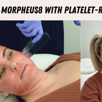 Morpheus 8 with Platelet Rich Fibrin Review