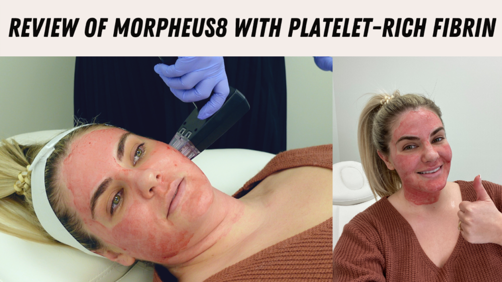 Morpheus 8 with Platelet Rich Fibrin Review