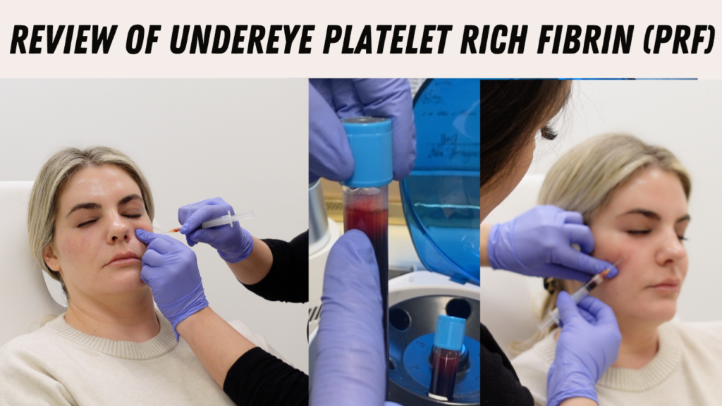 Fix your Undereye Issues with Platelet Rich Fibrin