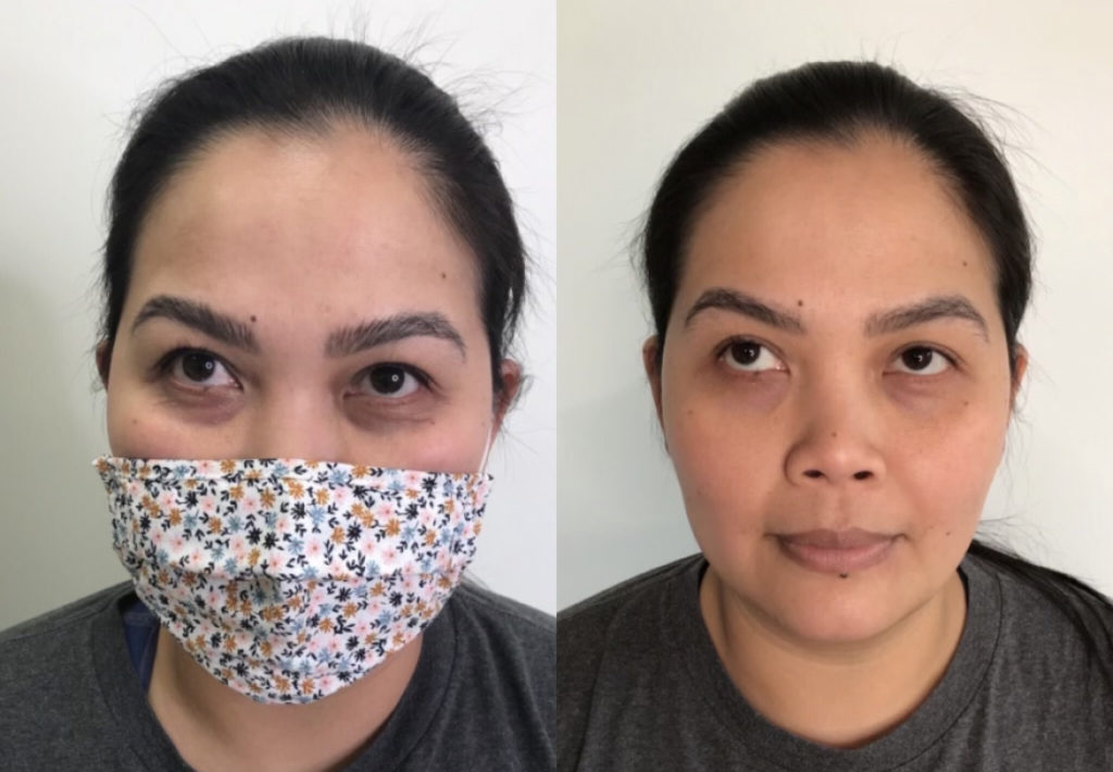 PRF under eye before and after