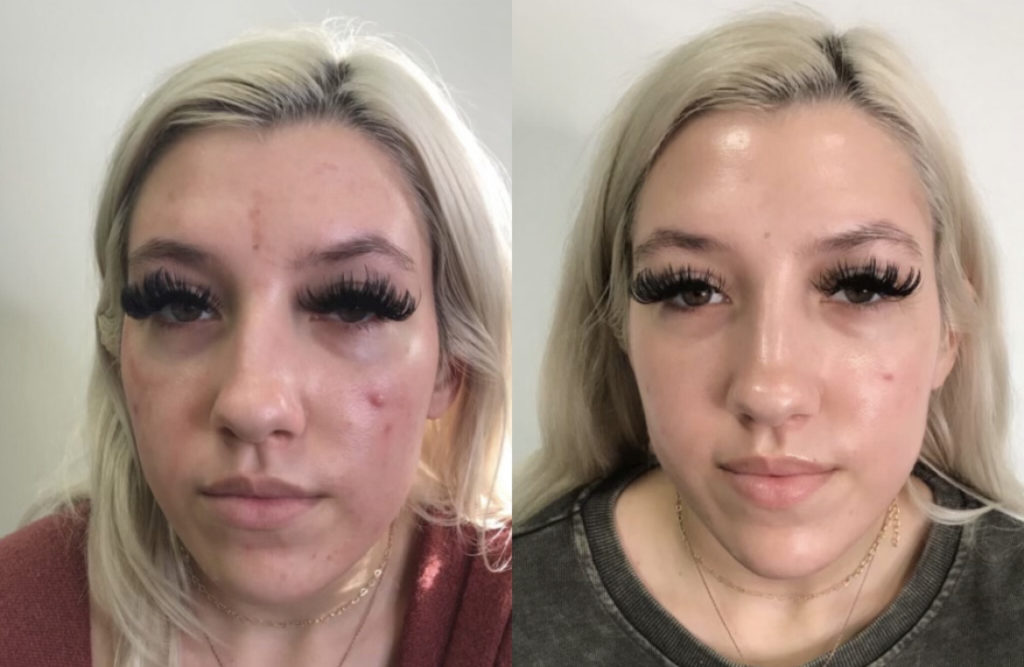 PRF under eye before and after Lauren Erro