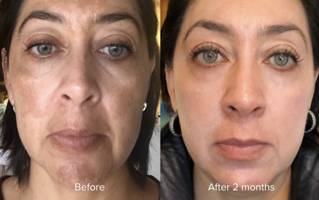 Exactly one month on 4% hydroquinone : r/Melasmaskincare