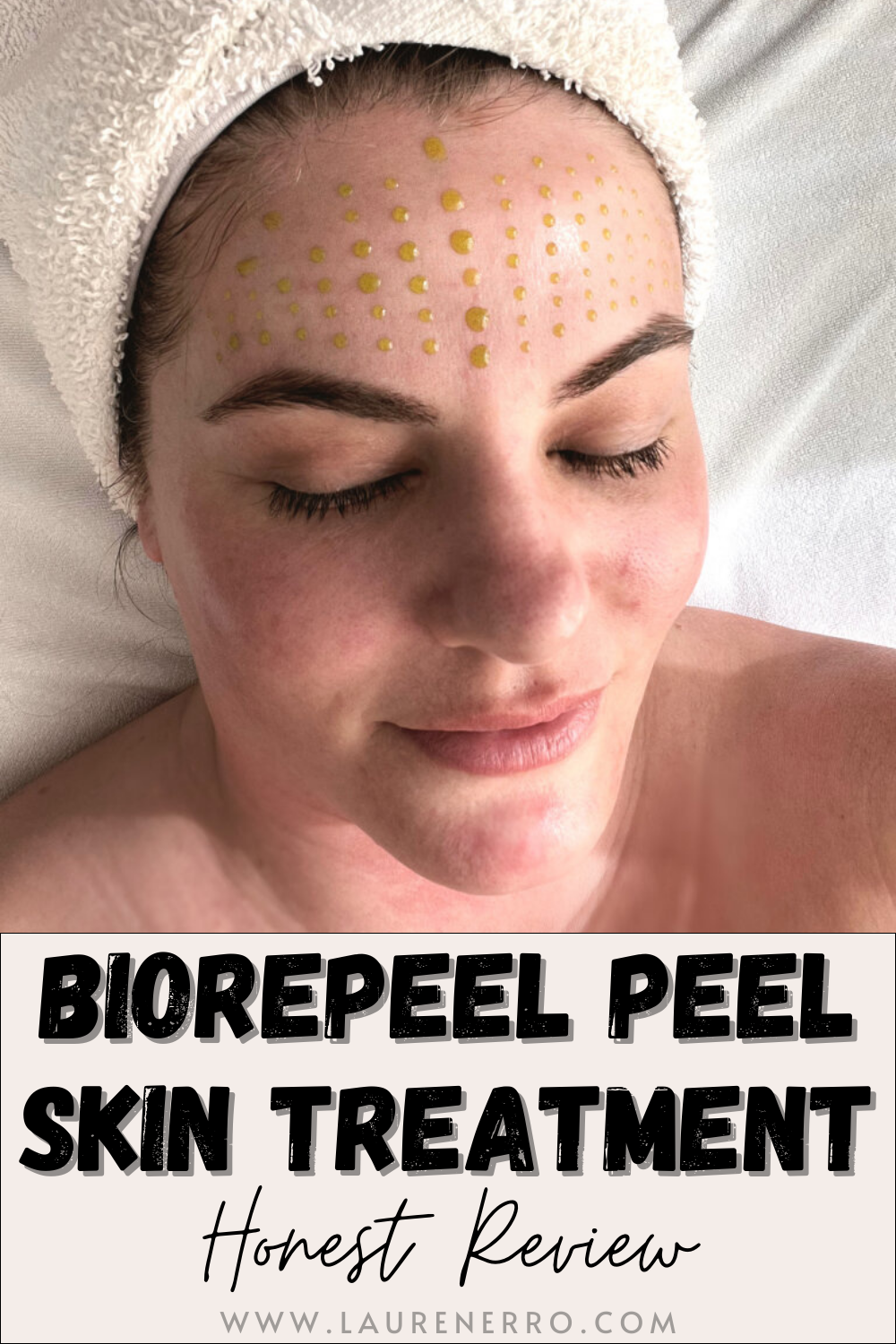 Honest review of the BioRepeel Peel Skin Treatment